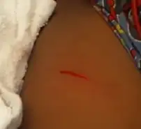 An injury from a stabbing epi-pen motion